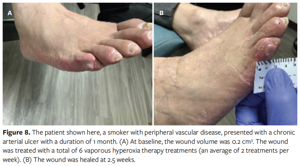 Clinical Studies on Vaporox | Proven Results in Chronic Wound Healing